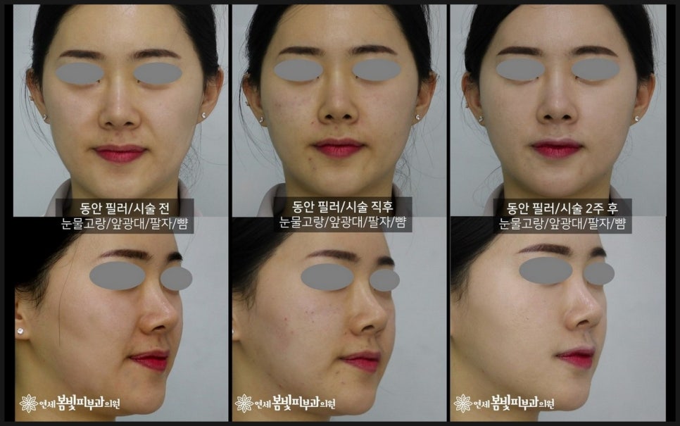 동안필러 치료 예시 #3,4 (앞광대필러, 팔자필러, 눈물도랑필러, 볼꺼짐필러) 관련 이미지 1