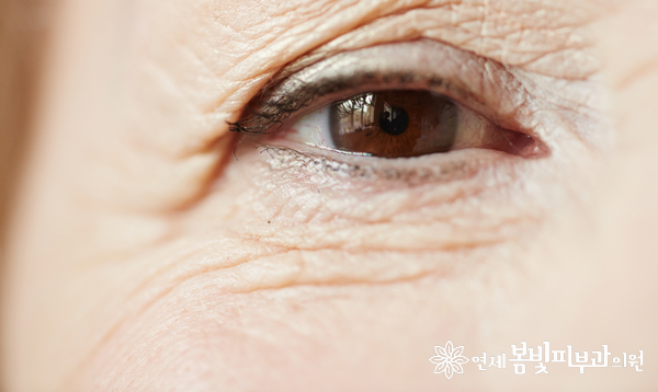 다크써클 없애는법 #3 (다크써클 치료: 레이저 치료, 색소 레이저, 레이저 토닝, 혈관 레이저, 탄력 레이저, 하이푸) 관련 이미지 8