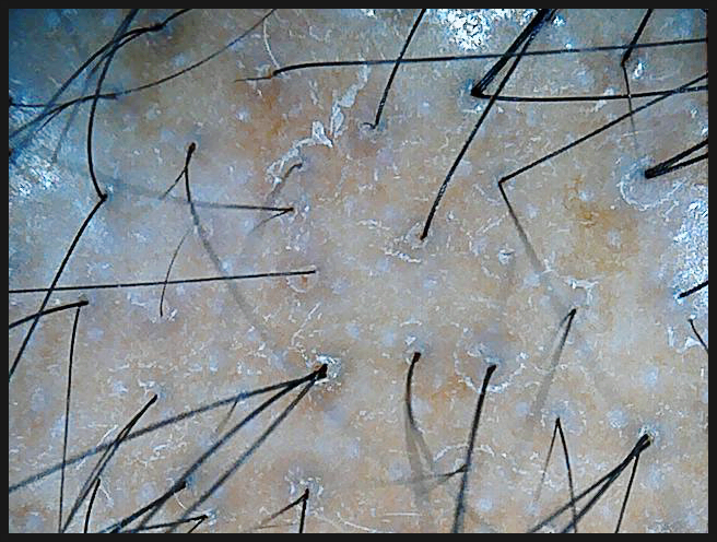 연세봄빛피부과 탈모치료 예시 (남성형탈모, 정수리탈모) 관련 이미지 5