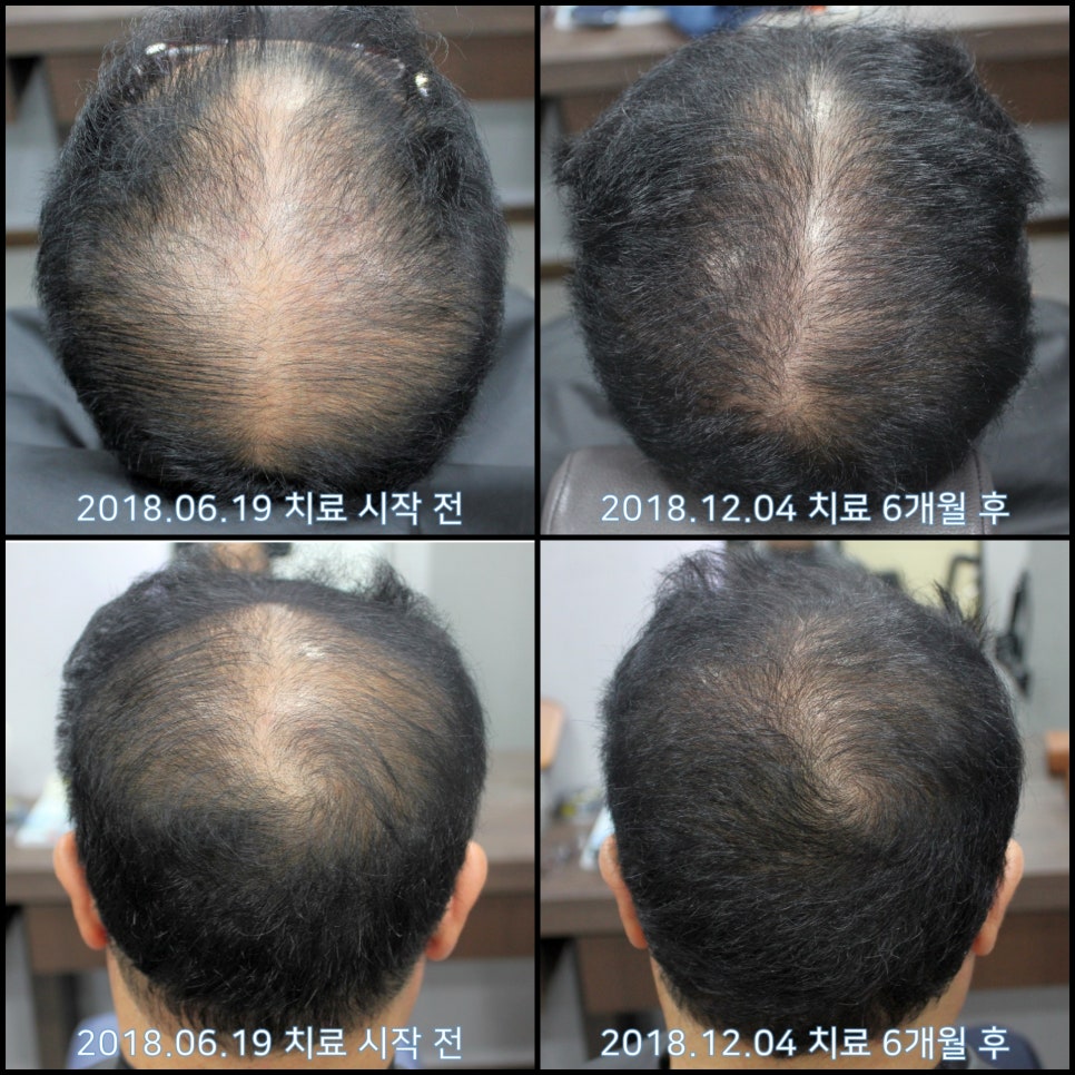연세봄빛피부과 탈모치료 #16 (남성형탈모, 이마탈모, 정수리탈모, 3단계) 관련 이미지 10