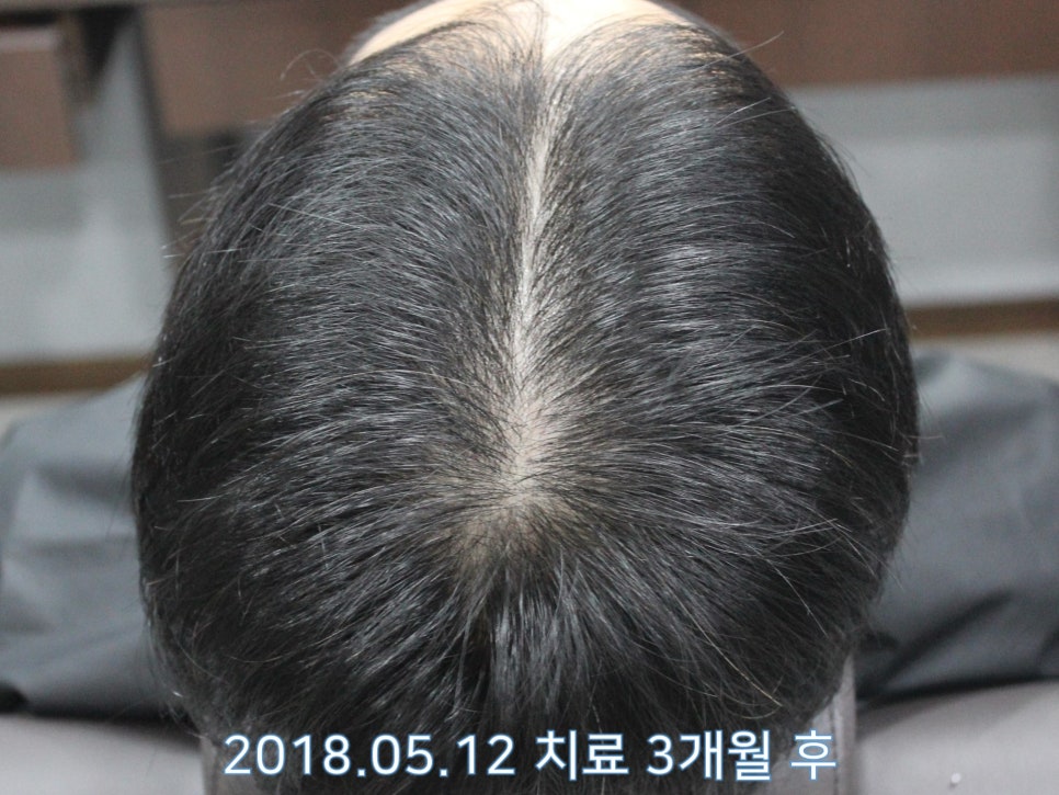 연세봄빛피부과 탈모치료 #18 (남성형탈모, 이마탈모, 정수리탈모, 모발이식 후 치료) 관련 이미지 6