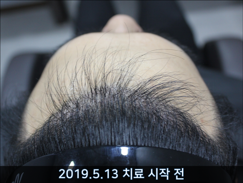 연세봄빛피부과 탈모치료 #34 (남성형탈모, 모발이식 후 치료) 관련 이미지 1