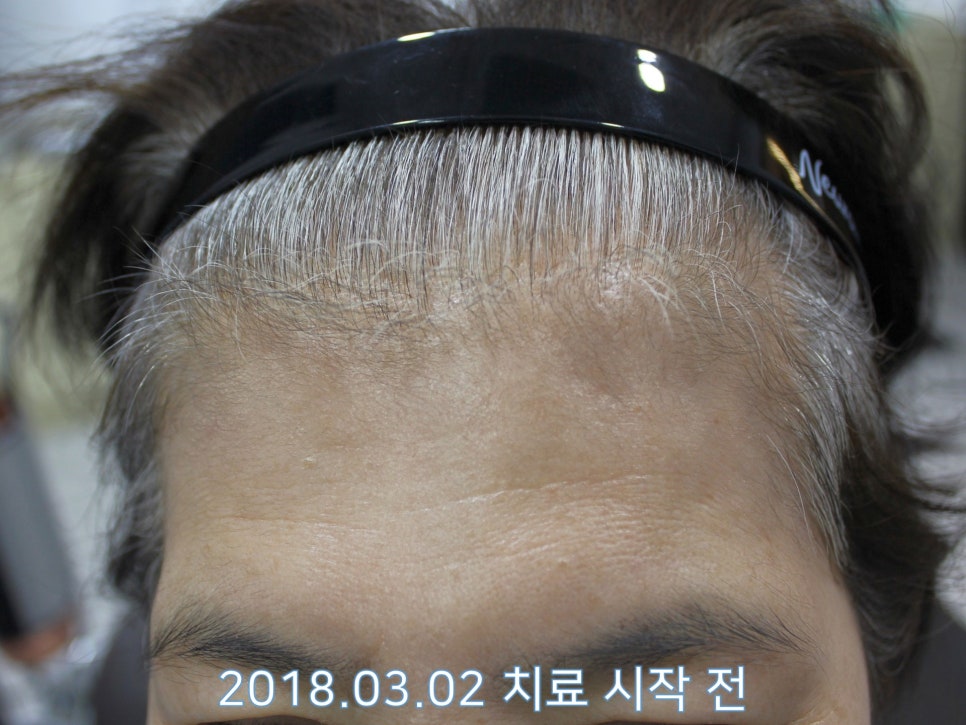 연세봄빛피부과 탈모치료 #19 (여성형탈모, 이마탈모, 정수리탈모, 부분가발) 관련 이미지 1