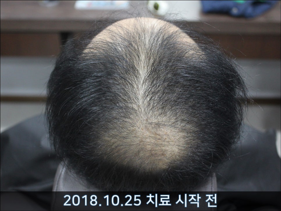 연세봄빛피부과 탈모치료 #30 (남성형탈모, 이마탈모, 정수리탈모) 관련 이미지 1