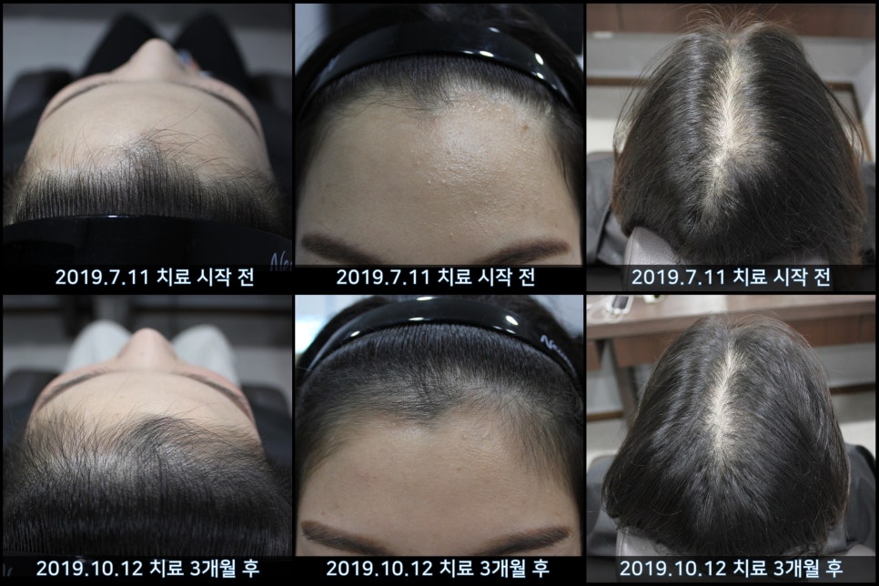 연세봄빛피부과 탈모치료 #38 (여성형탈모, 여성이마탈모) 관련 이미지 7