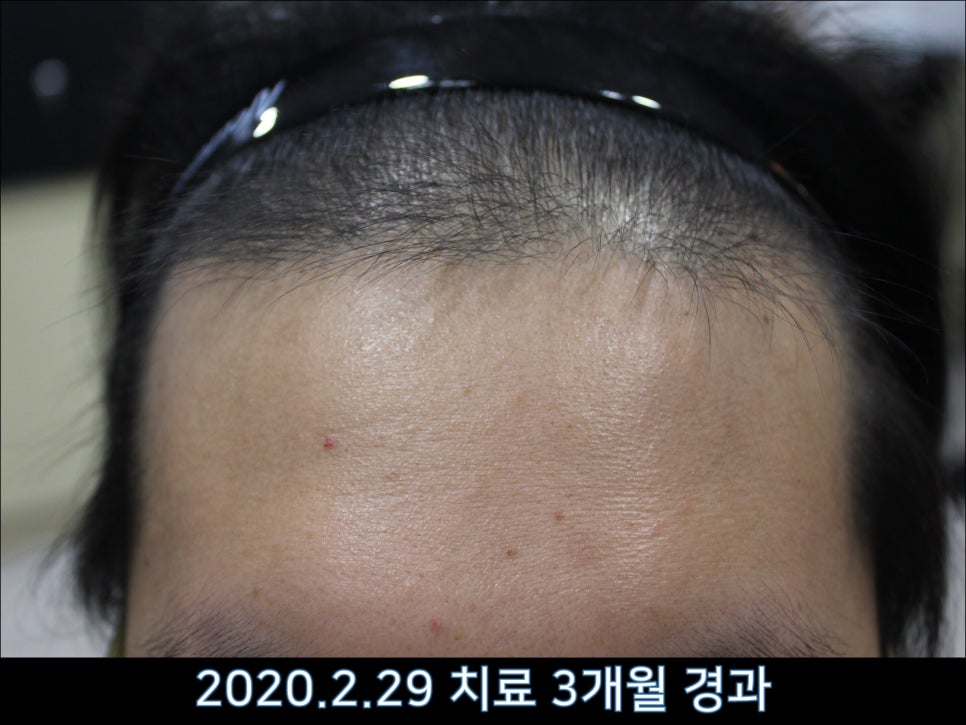 연세봄빛피부과 탈모치료 #43 (정수리탈모, F형 탈모) 관련 이미지 8