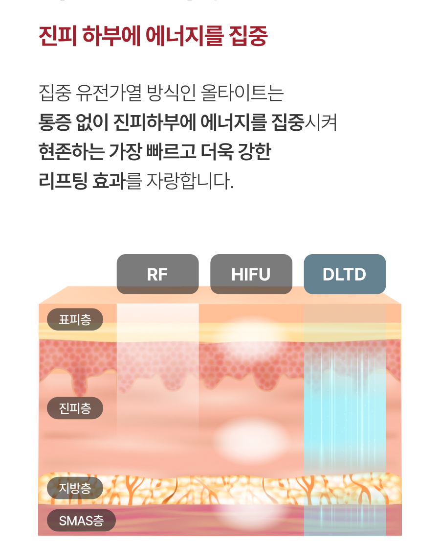 통증 적고 즉각적인 전층 콜라겐 리프팅, 올타이트를 소개합니다. 관련 이미지 5