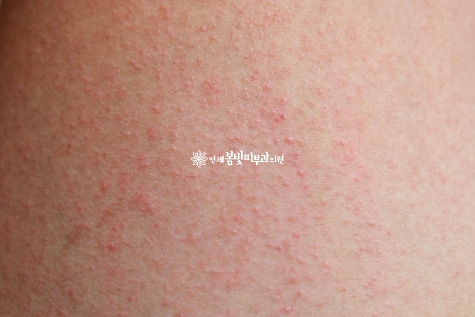 땀과 피부질환 관련 이미지 2