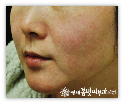 안면홍조 없애는법 #1 (안면홍조원인, 안면홍조증상) 관련 이미지 2
