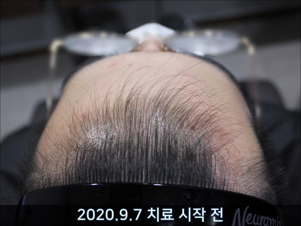 연세봄빛피부과 탈모치료 #32 (남성형탈모, 이마탈모, 정수리탈모, 두피보톡스) 관련 이미지 3
