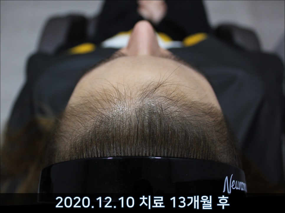 연세봄빛피부과 탈모치료 #40 (여성형탈모, 외국인의 경우) 관련 이미지 5