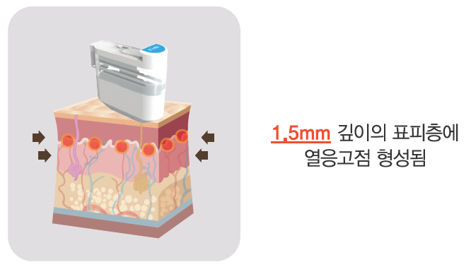 리프팅 레이저의 새로운 강자, 울트라스킨 플러스 도입 관련 이미지 4