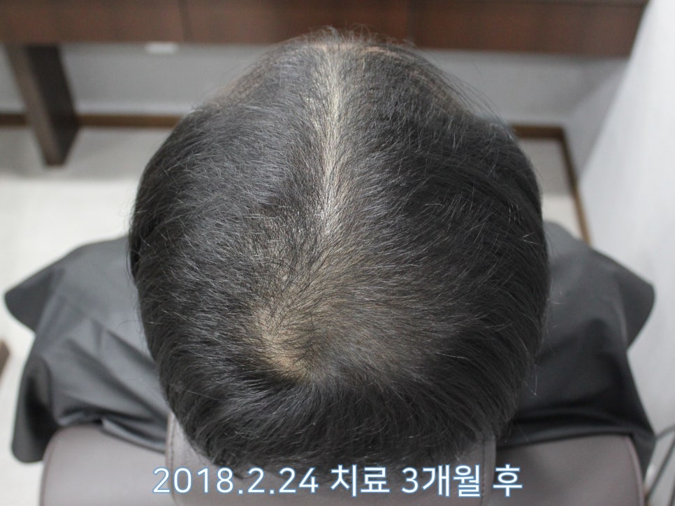 연세봄빛피부과 탈모치료 #8 (남성형탈모, 이마탈모, 정수리탈모) 관련 이미지 4