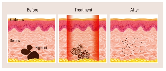 짙은 색소만 골라서 빠르게 공략~ 마이크로 토닝! 관련 이미지 3