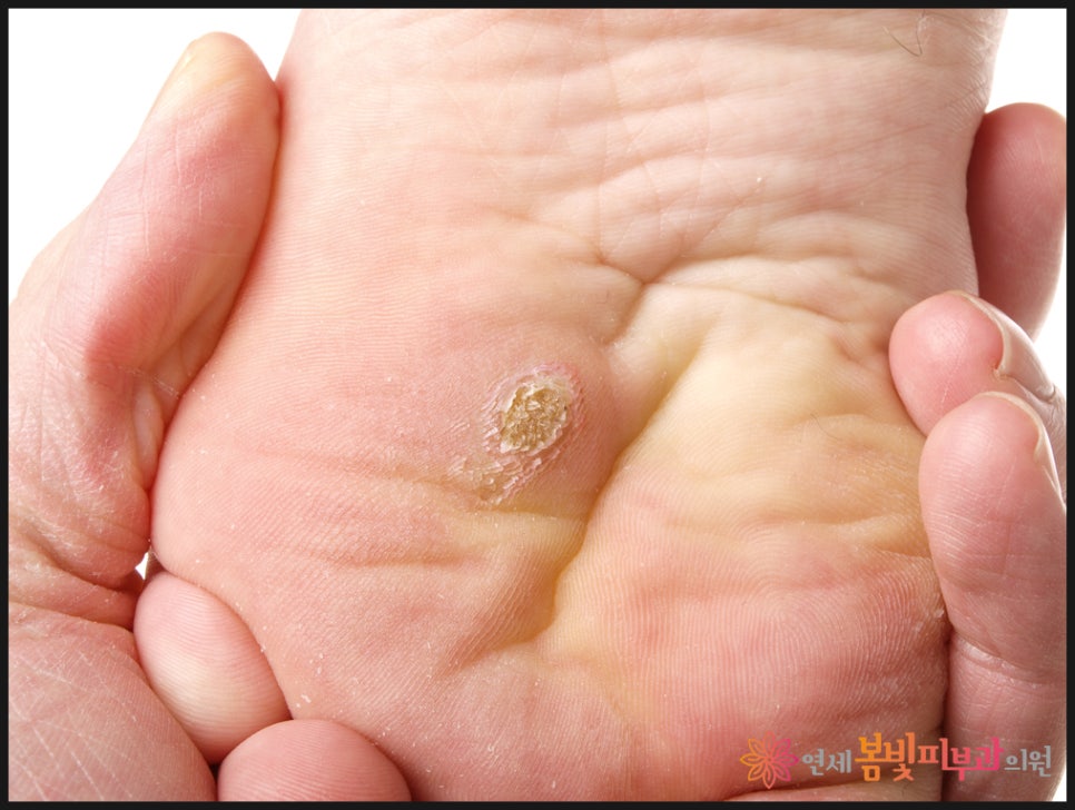 바이러스성 사마귀는 왜 자꾸 생길까요? (보통 사마귀, 편평 사마귀, 손발바닥 사마귀, 냉동치료,  블레오마이신 주사 치료, 레이저 치료) 관련 이미지 2