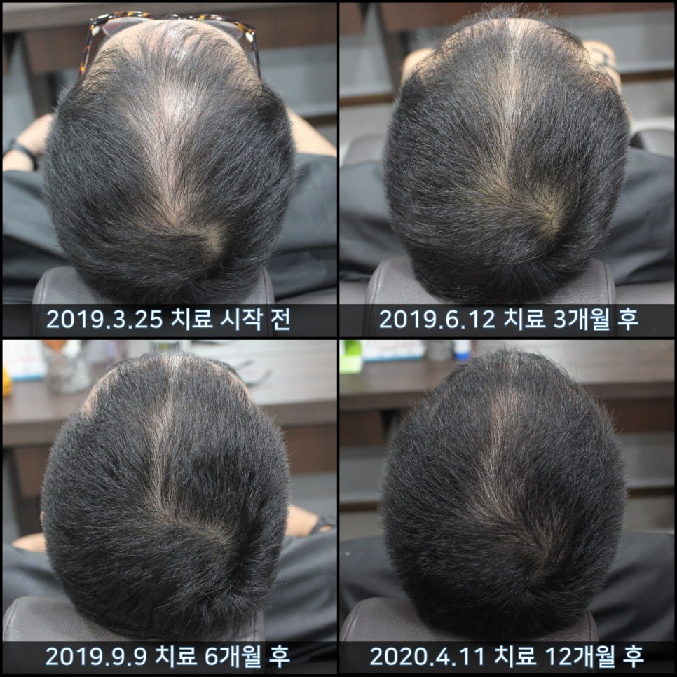 연세봄빛피부과 탈모치료 #41 (남성형탈모, 정수리탈모) 관련 이미지 5