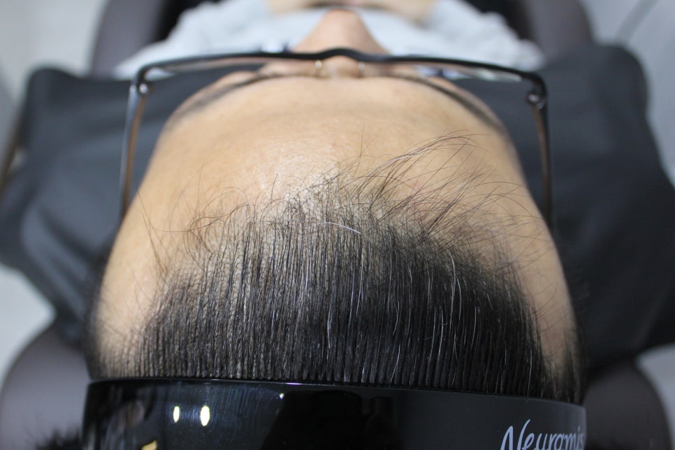 연세봄빛피부과 탈모치료 #5 (남성형탈모, 이마탈모, 정수리탈모) 관련 이미지 1