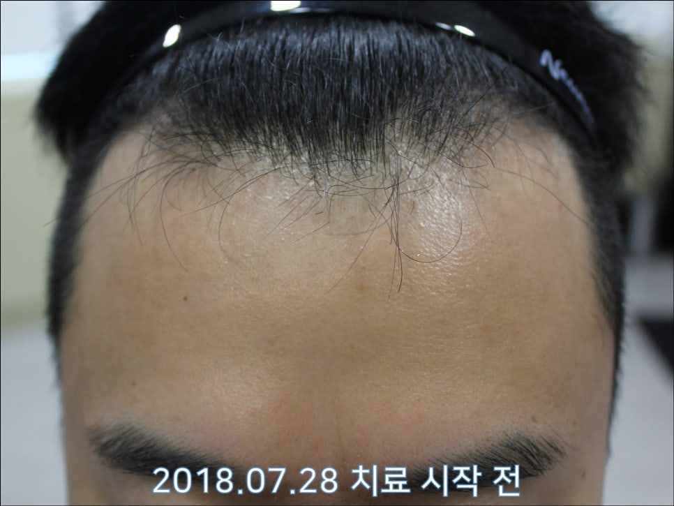 연세봄빛피부과 탈모치료 #27 (남성형탈모, 이마탈모 정수리탈모) 관련 이미지 1