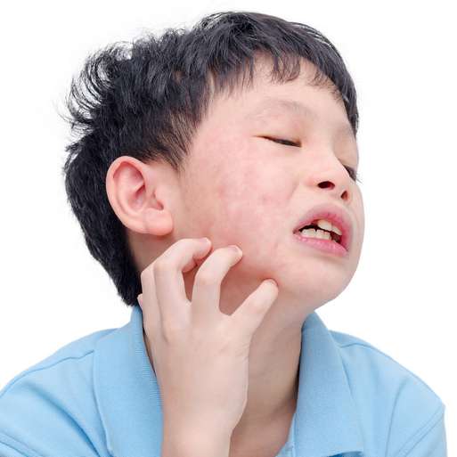 뉴질랜드에 가면 아토피가 좋아질까? (아토피원인) 관련 이미지 1