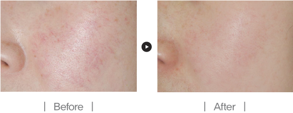 피코 레이저의 베스트셀러, 피코케어 도입 관련 이미지 6