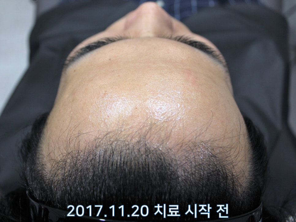 연세봄빛피부과 탈모치료 #13 (남성형탈모, 이마탈모) 관련 이미지 1