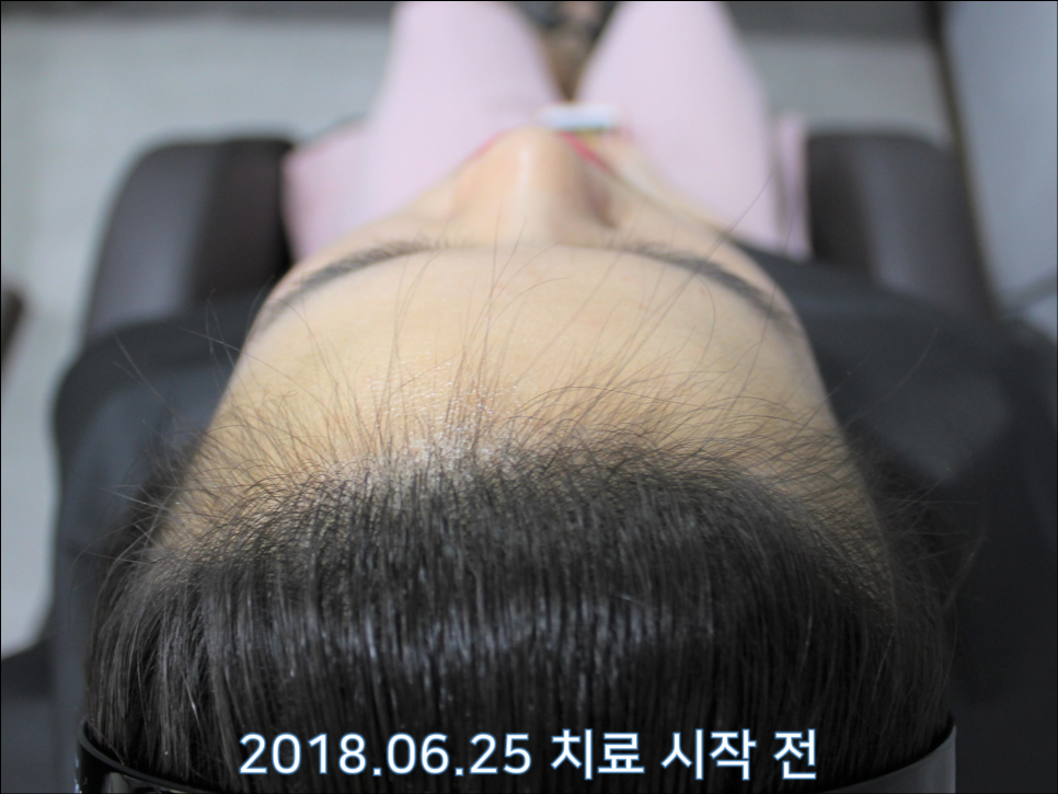 연세봄빛피부과 탈모치료 #24 (여성형 탈모, 이마탈모, 정수리탈모) 관련 이미지 4