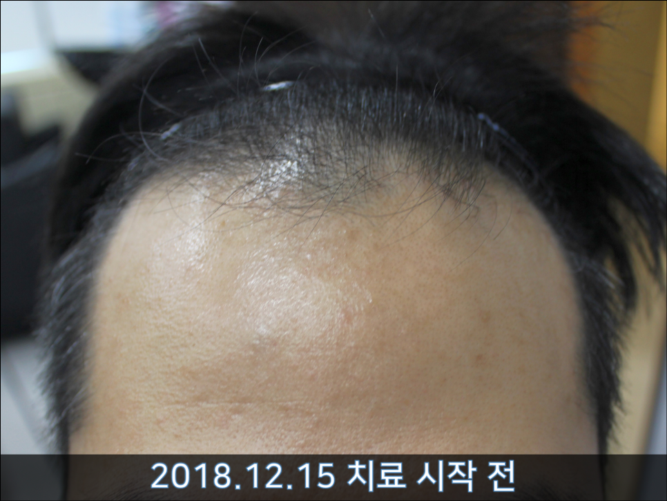 연세봄빛피부과 탈모치료 #36 (남성형탈모, 이마탈모, 3개월) 관련 이미지 3