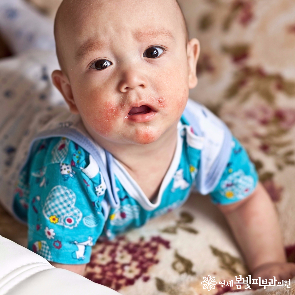 아토피피부염 환자의 가을, 겨울철 피부 관리 관련 이미지 1