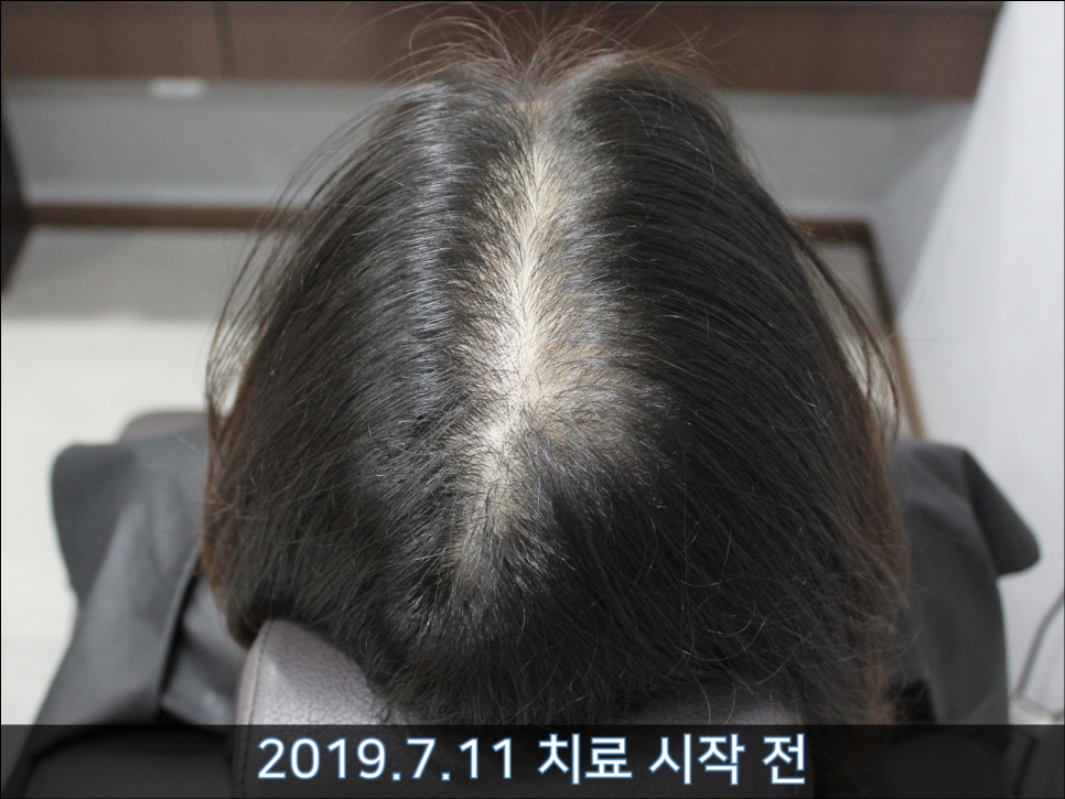 연세봄빛피부과 탈모치료 #38 (여성형탈모, 여성이마탈모) 관련 이미지 5
