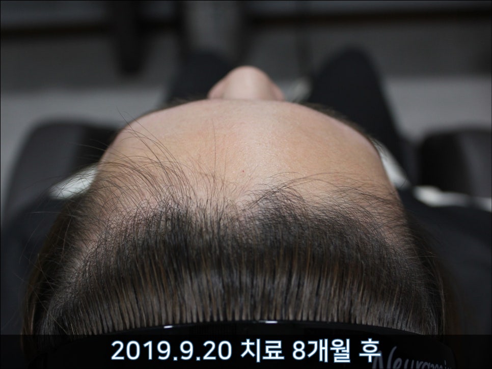 연세봄빛피부과 탈모치료 #37 (여성형탈모, 정수리탈모) 관련 이미지 6