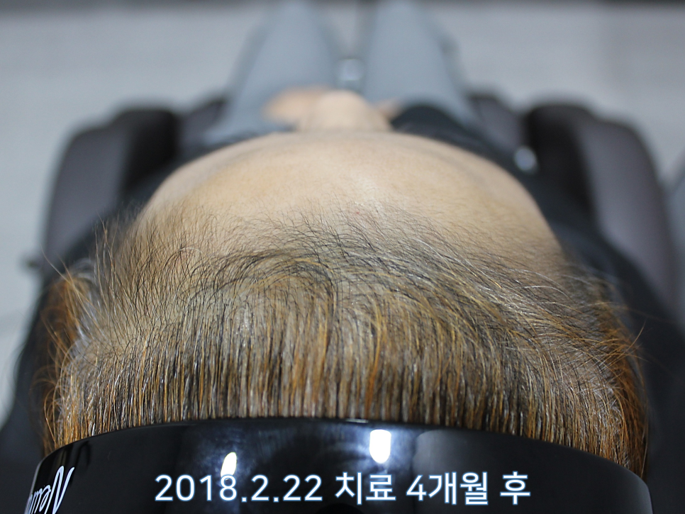 연세봄빛피부과 탈모치료 #6 (여성형탈모, 정수리탈모) 관련 이미지 5