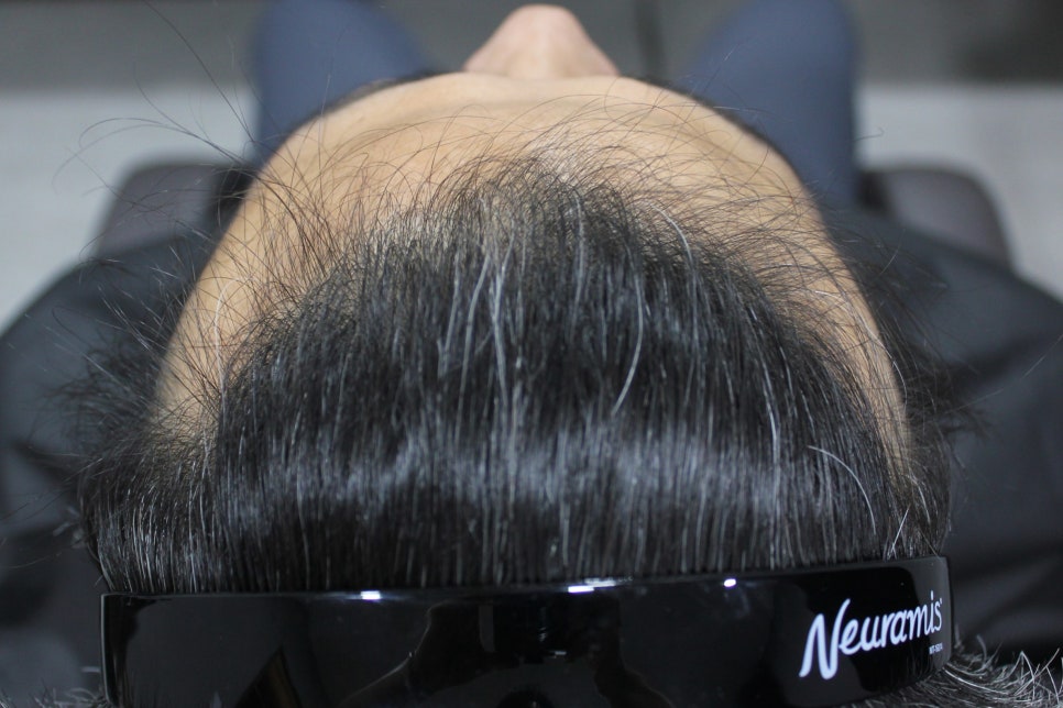 연세봄빛피부과 탈모치료 #5 (남성형탈모, 이마탈모, 정수리탈모) 관련 이미지 3