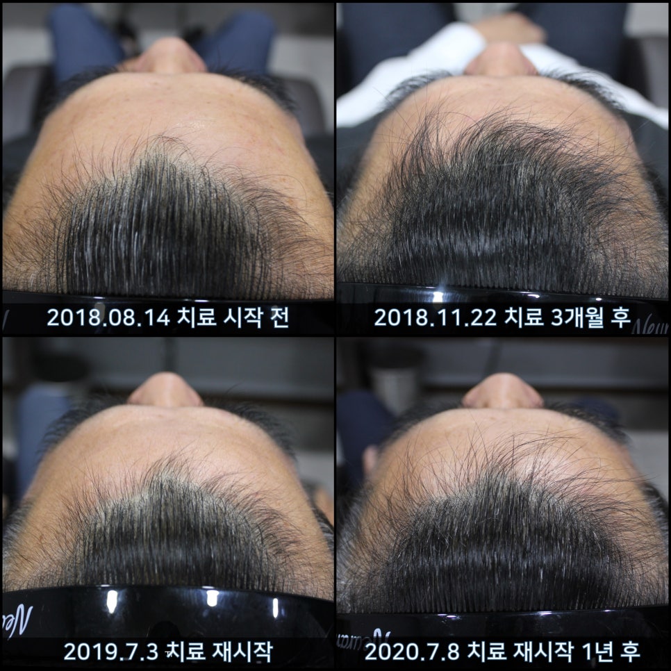 연세봄빛피부과 탈모치료 #39 (남성형탈모, 치료 중단 후 재치료) 관련 이미지 6
