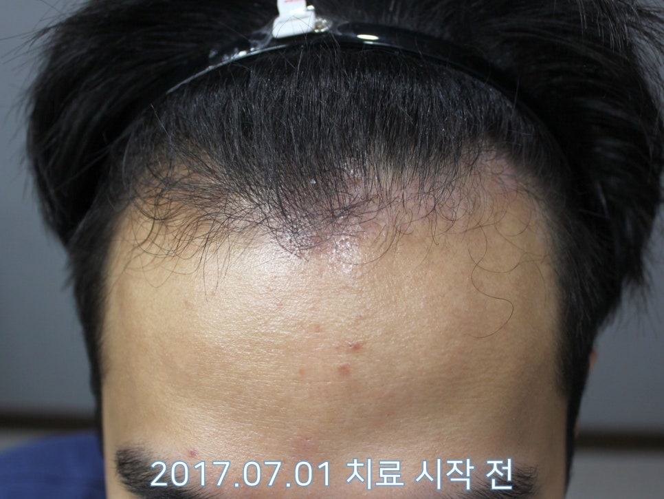 연세봄빛피부과 탈모치료 #14 (남성형탈모, 이마탈모) 관련 이미지 3