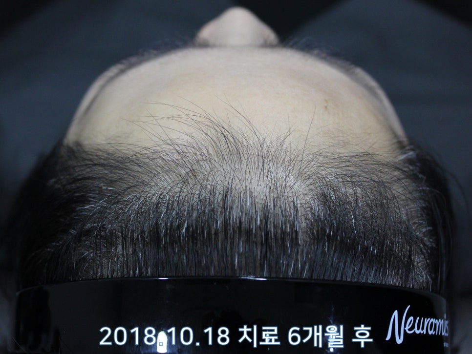 연세봄빛피부과 탈모치료 #21 (여성형탈모, 이마탈모) 관련 이미지 6