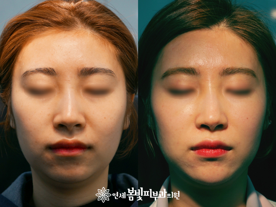 동안필러 치료 예시 #1,2 (앞광대필러, 눈물도랑필러, 볼꺼짐필러) 관련 이미지 2