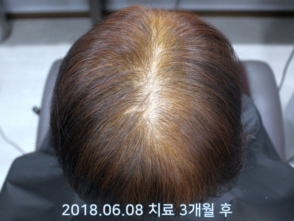 연세봄빛피부과 탈모치료 #19 (여성형탈모, 이마탈모, 정수리탈모, 부분가발) 관련 이미지 4