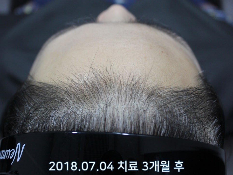 연세봄빛피부과 탈모치료 #21 (여성형탈모, 이마탈모) 관련 이미지 4