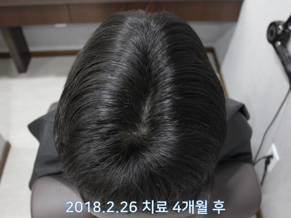 연세봄빛피부과 탈모치료 #12 (남성형탈모, 이마탈모, 정수리탈모) 관련 이미지 4