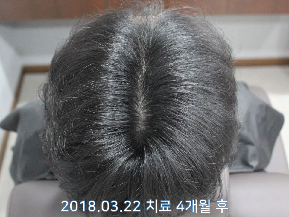 연세봄빛피부과 탈모치료 #13 (남성형탈모, 이마탈모) 관련 이미지 5