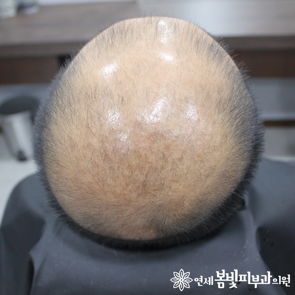 연세봄빛피부과 탈모치료 예시 (남성형탈모, 정수리탈모) 관련 이미지 1