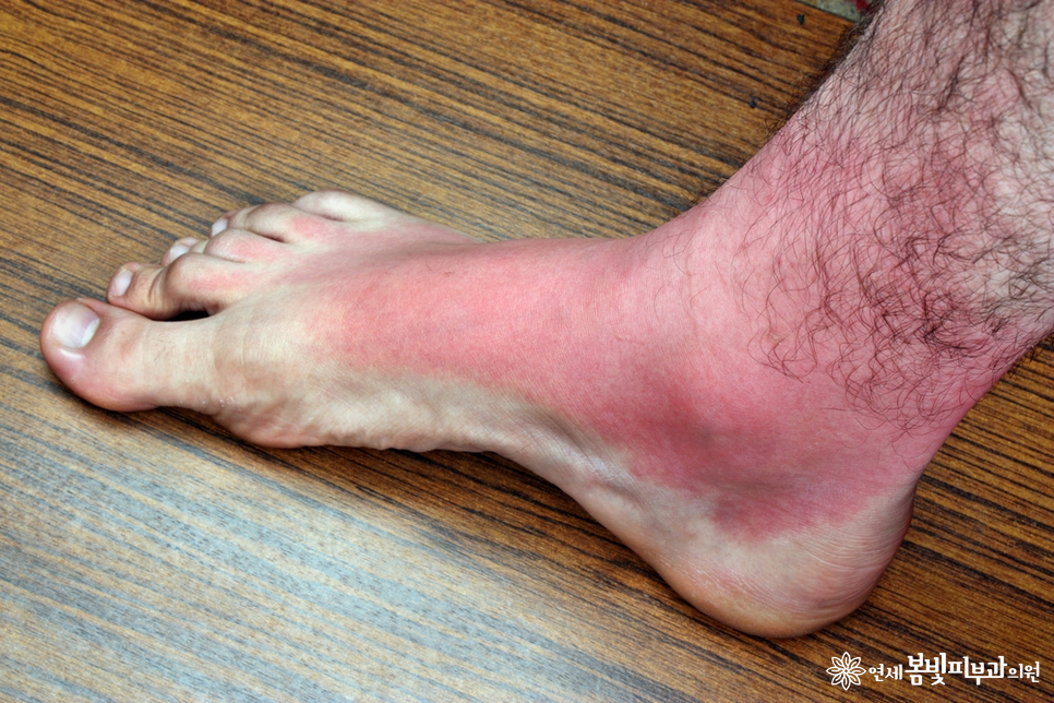 화상, 화상치료, 화상흉터치료 잘 하는 법 (화상병원, 화상피부과) 관련 이미지 2