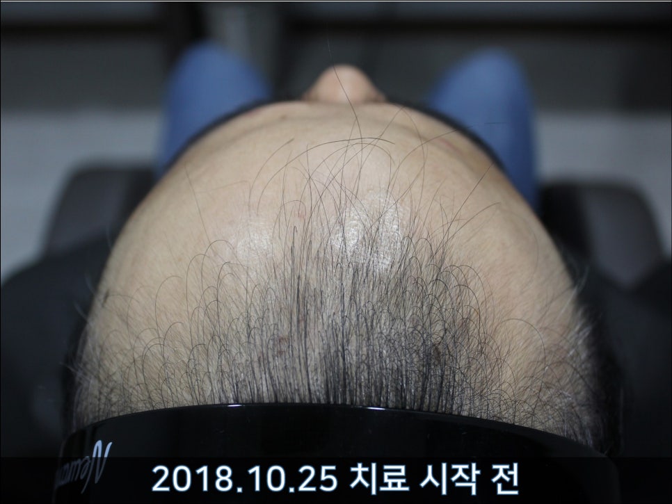 연세봄빛피부과 탈모치료 #30 (남성형탈모, 이마탈모, 정수리탈모) 관련 이미지 5