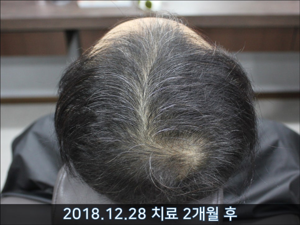 연세봄빛피부과 탈모치료 #30 (남성형탈모, 이마탈모, 정수리탈모) 관련 이미지 2