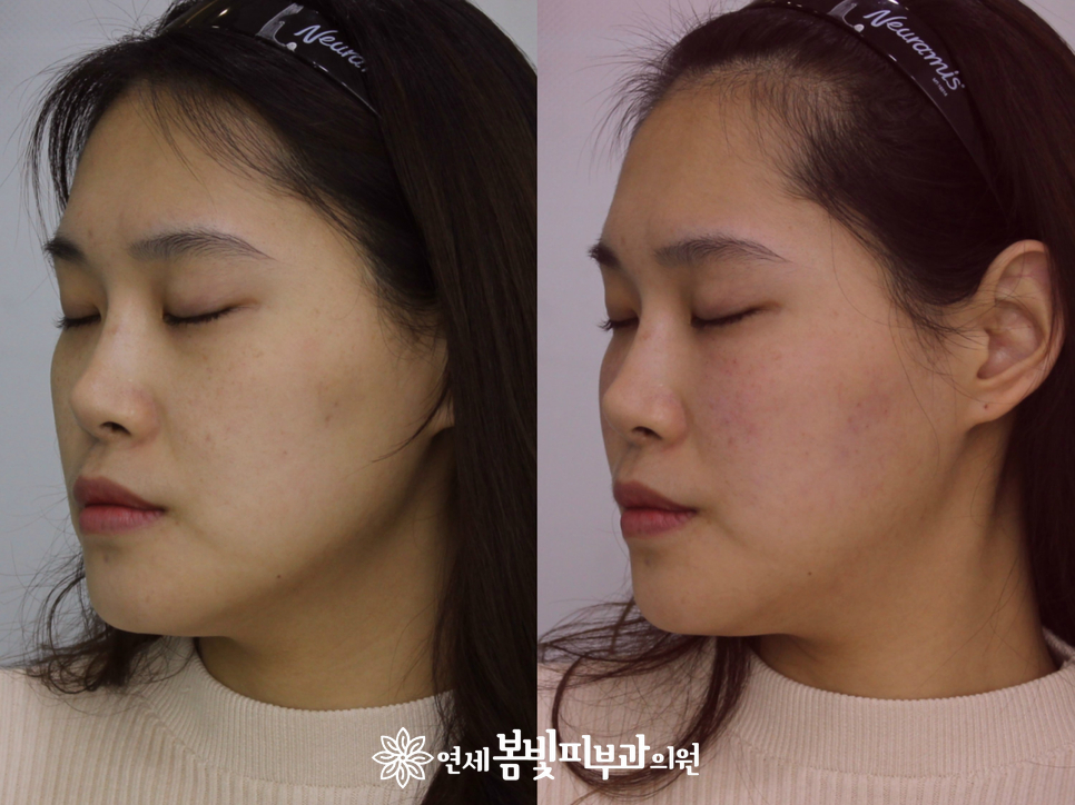 동안필러 치료 예시 #1,2 (앞광대필러, 눈물도랑필러, 볼꺼짐필러) 관련 이미지 5