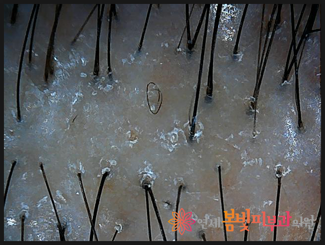 연세봄빛피부과 탈모치료 #10 (여성형탈모, 정수리탈모) 관련 이미지 2