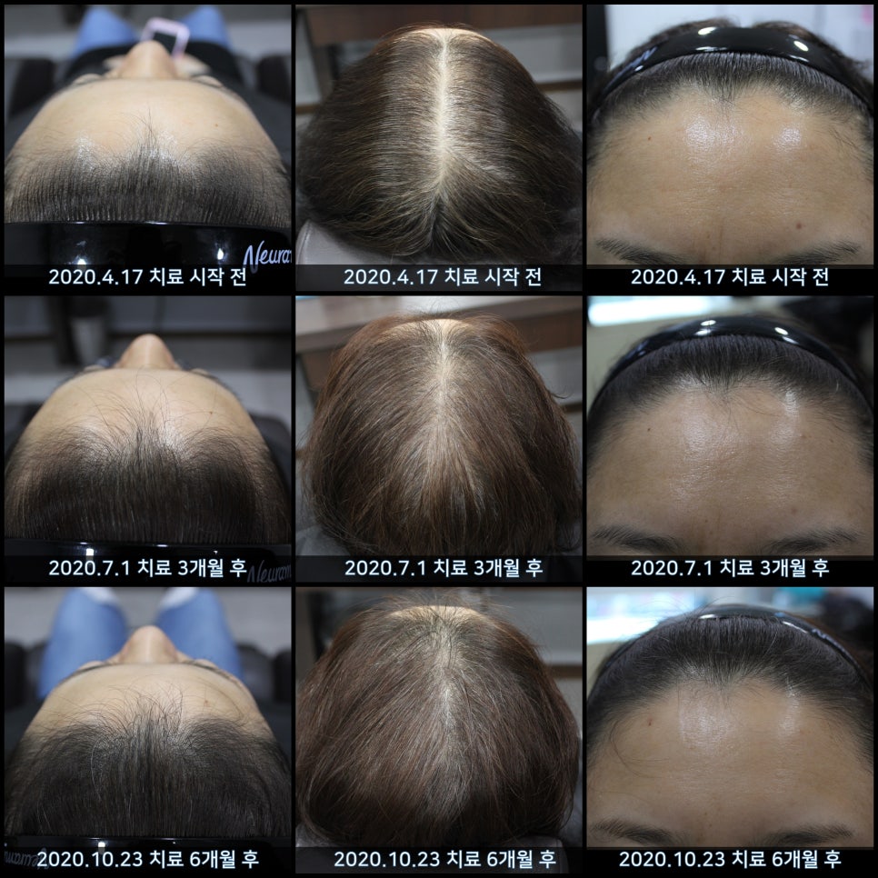 연세봄빛피부과 탈모치료 #45 (AI를 이용한 탈모 치료 성과 분석) 관련 이미지 8