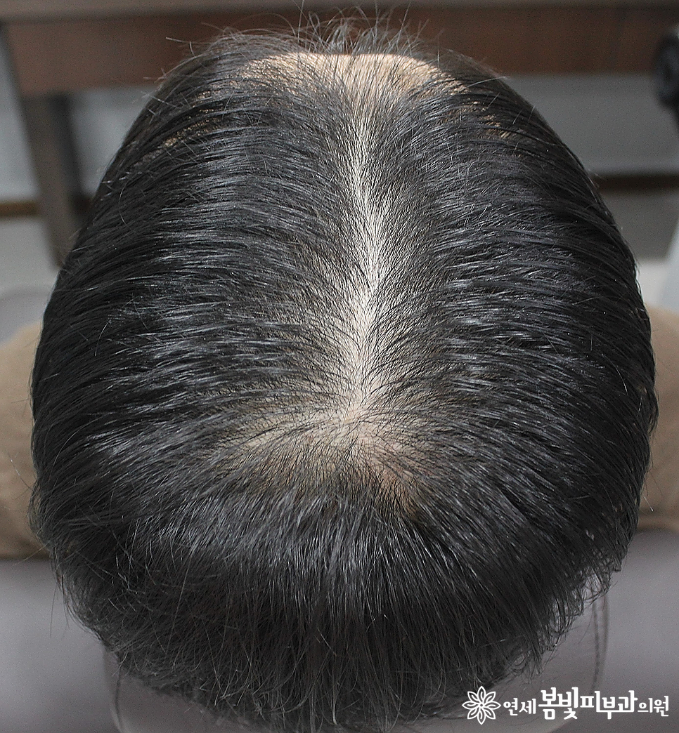 연세봄빛피부과 탈모치료 #2 (남성형탈모, 이마탈모, 정수리탈모) 관련 이미지 1