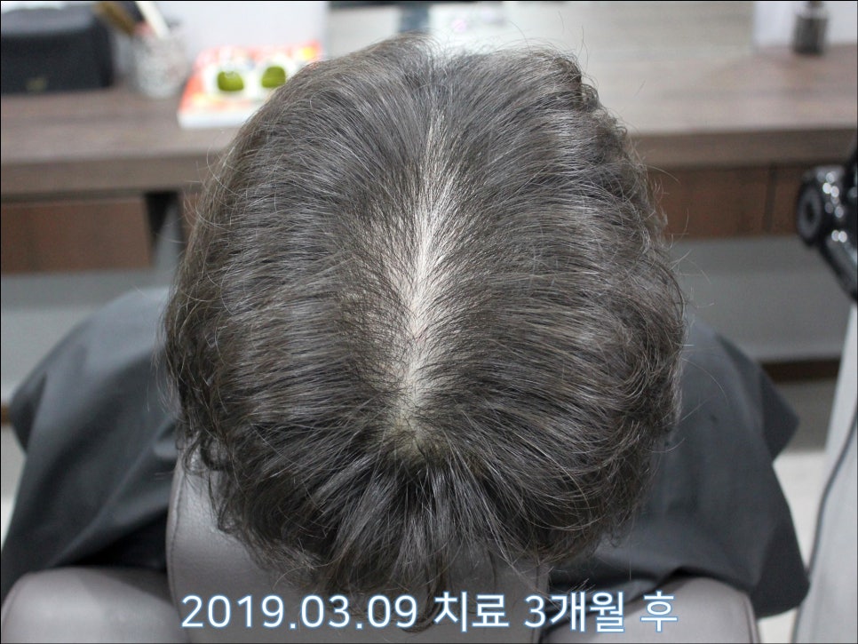 연세봄빛피부과 탈모치료 #28 (남성형탈모, 정수리탈모) 관련 이미지 2