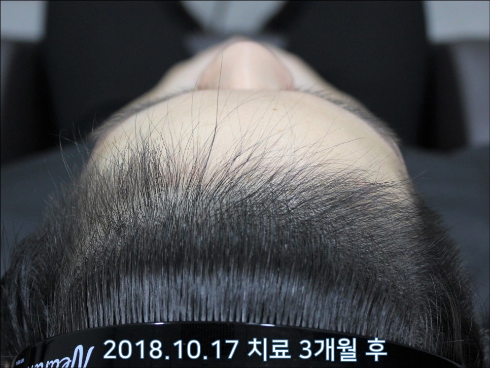 연세봄빛피부과 탈모치료 #26 (남성형탈모, 이마탈모) 관련 이미지 4